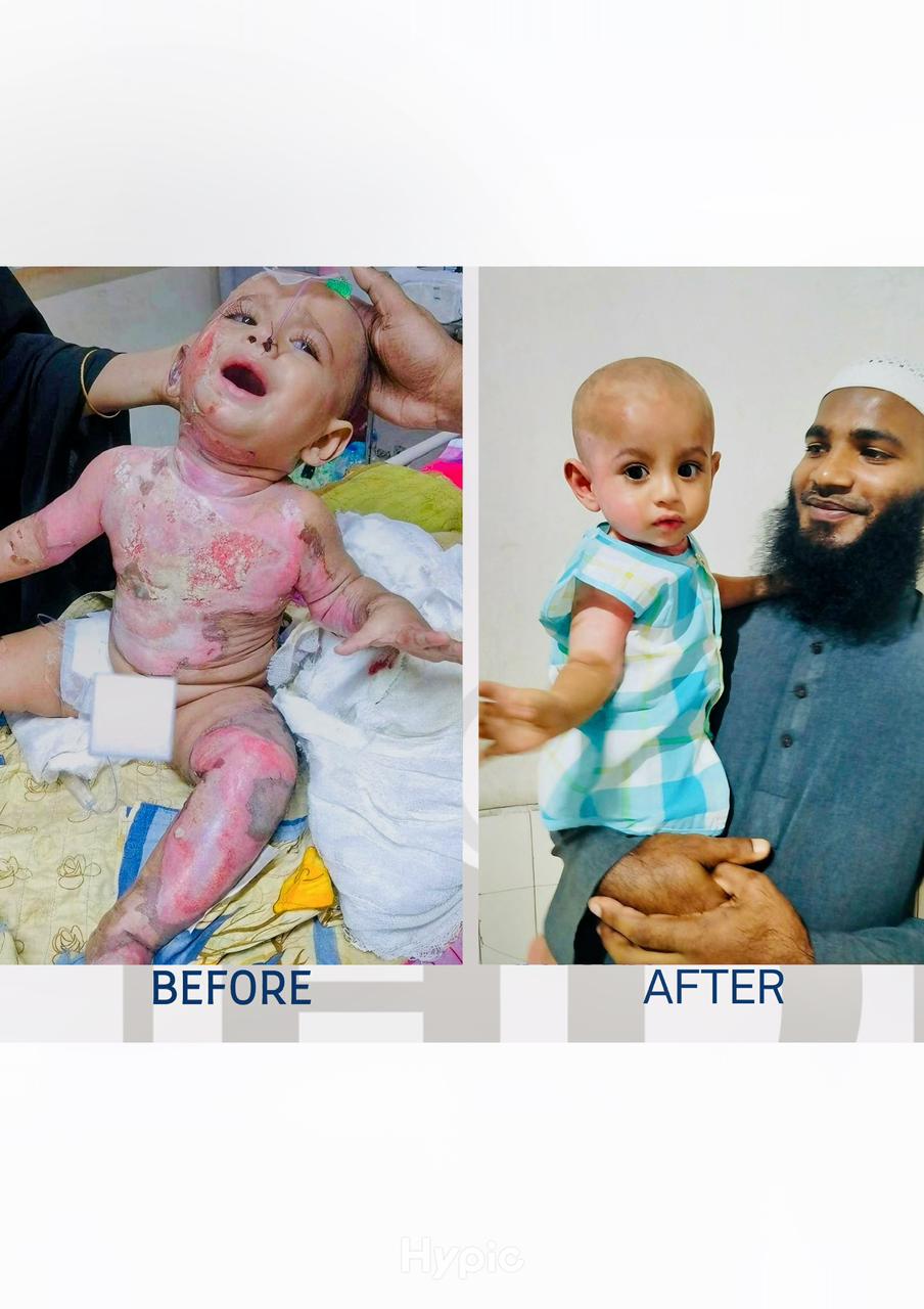 Before and after photos showing a child's recovery from burn injuries through medical treatment